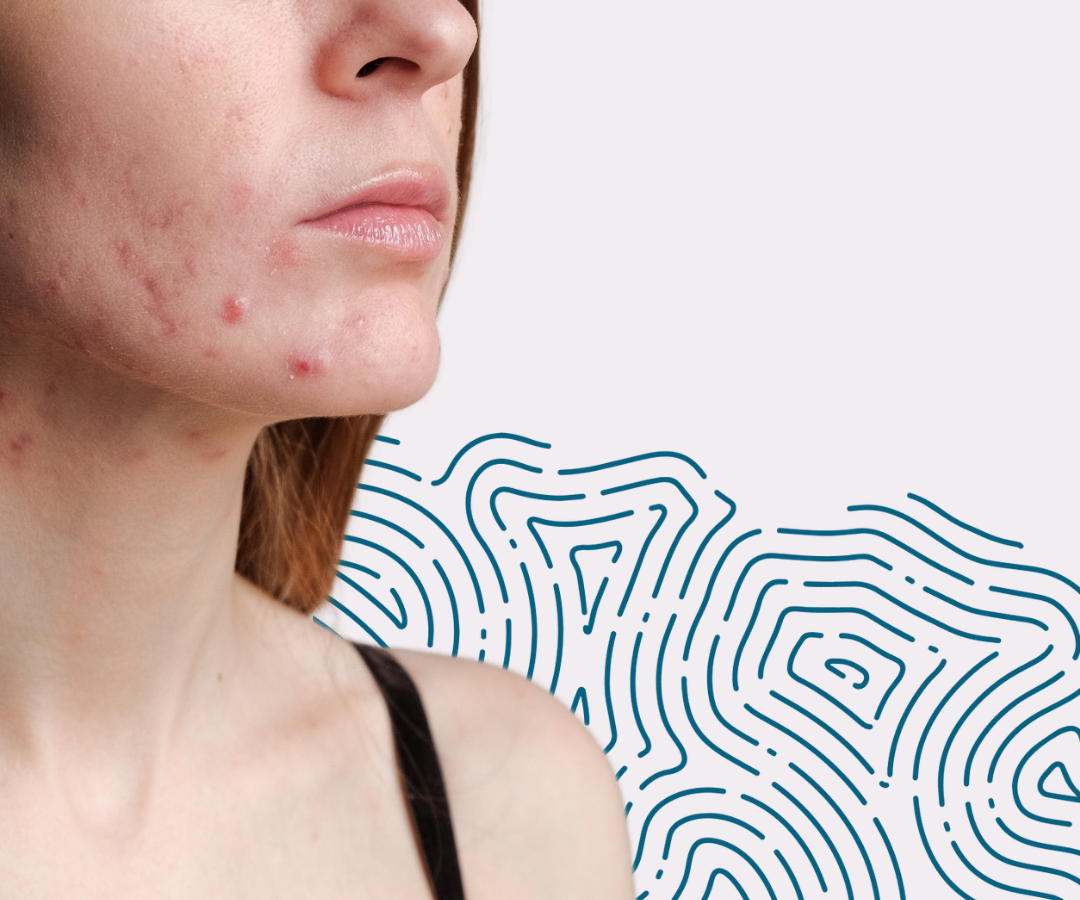 Why Blemishes Don’t Define Your Beauty - A Skincare Expert’s Guide to Managing Adult Breakouts
