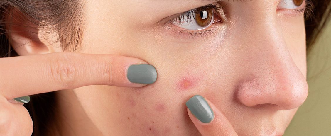 How to Identify and Treat Different Types of Acne: Your Comprehensive Guide to Skincare without Compromise